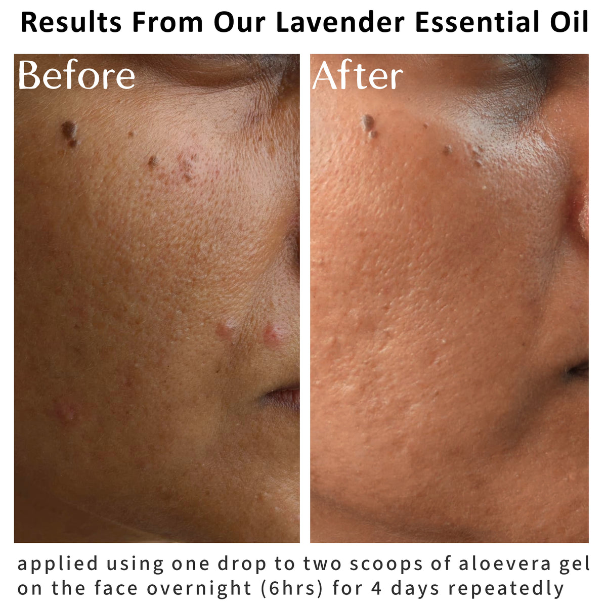 Before and after facial images showing reduced papules after using Himalayan lavender essential oil with aloe vera gel