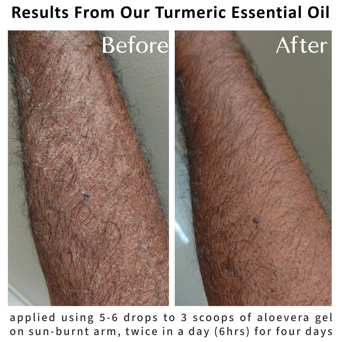 Before and after skin results of a sun-burnt arm after using turmeric essential oil with aloe vera gel